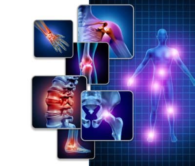 פיברומיאלגיה