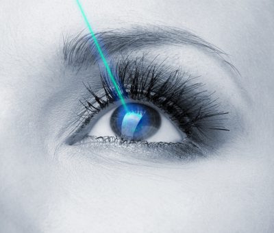 ניתוח לייזר בעיניים